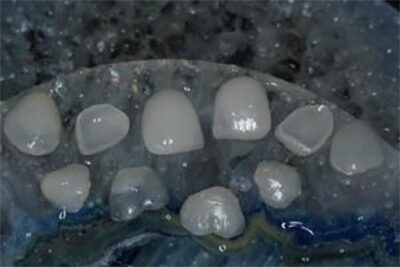 lentes de contatos dentais
