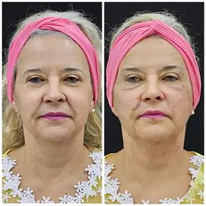 Endolift Antes e Depois