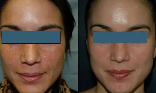 Peeling Enzimático Antes e Depois