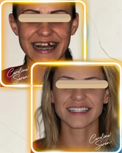 Antes e depois de rejuvenescimento facial com lentes de contato dental em Moema - Clínica Saran
